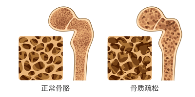 摄图网_401806710_正常骨质和骨质疏松对比医疗插画（企业商用）.jpg