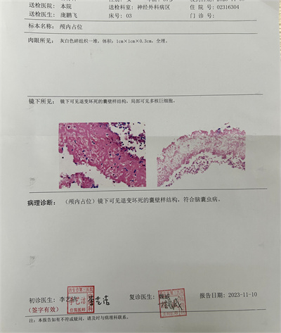 脑囊虫病理报告.jpg