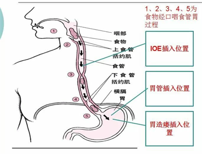 精准康复︱ioe技术  让吞咽障碍患者摆脱大象鼻