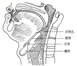 囊肿发生于颈正中线,自舌盲孔至胸骨切迹间的任何部位,但以舌骨上下部